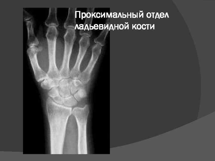 Проксимальный отдел ладьевидной кости 