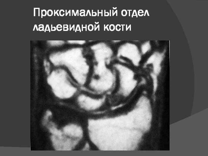 Проксимальный отдел ладьевидной кости 