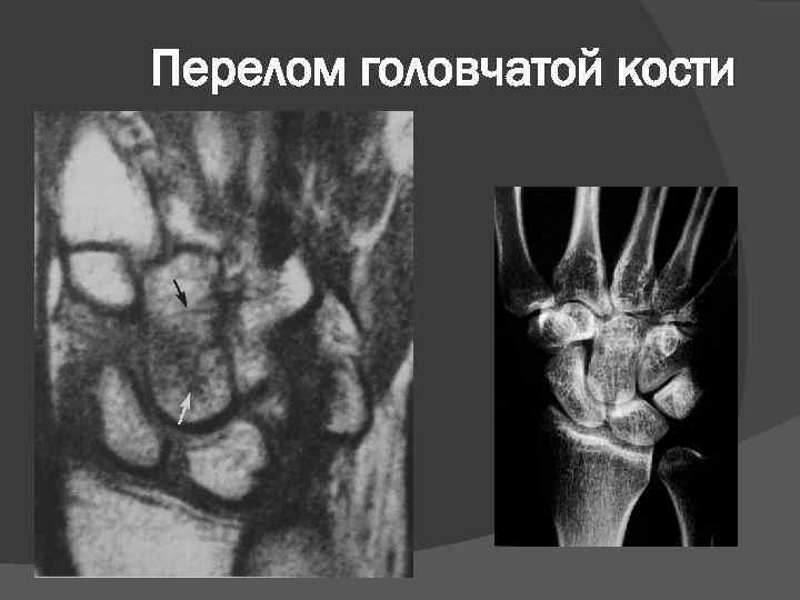 Перелом головчатой кости 