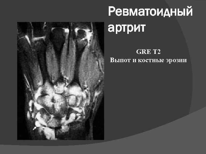 Ревматоидный артрит GRE T 2 Выпот и костные эрозии 