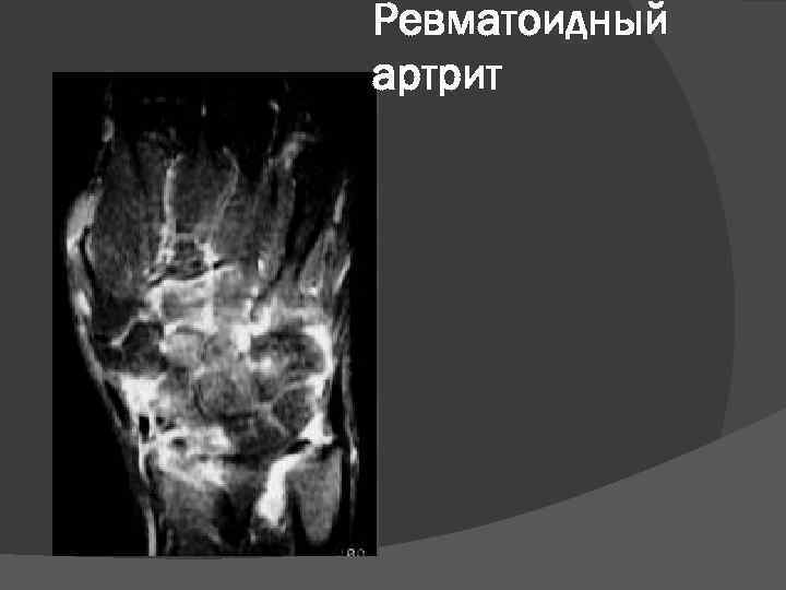 Ревматоидный артрит 