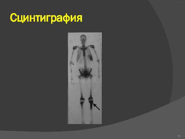 Сцинтиграфия 13 