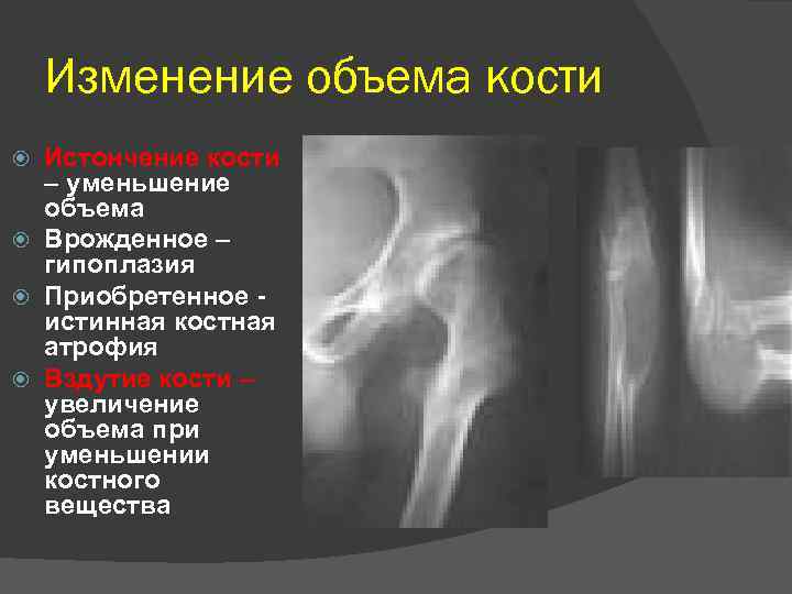 Изменение объема кости Истончение кости – уменьшение объема Врожденное – гипоплазия Приобретенное - истинная