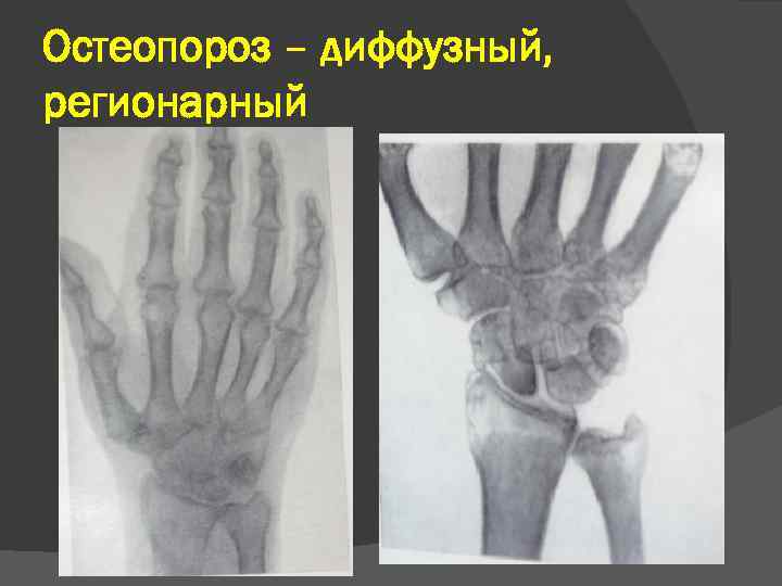 Остеопороз стопы. Регионарный остеопороз костей сустава. Диффузный остеопороз рентген. Пятнистый остеопороз костей кисти. Остеопороз лучевая диагностика костно-суставной системы.