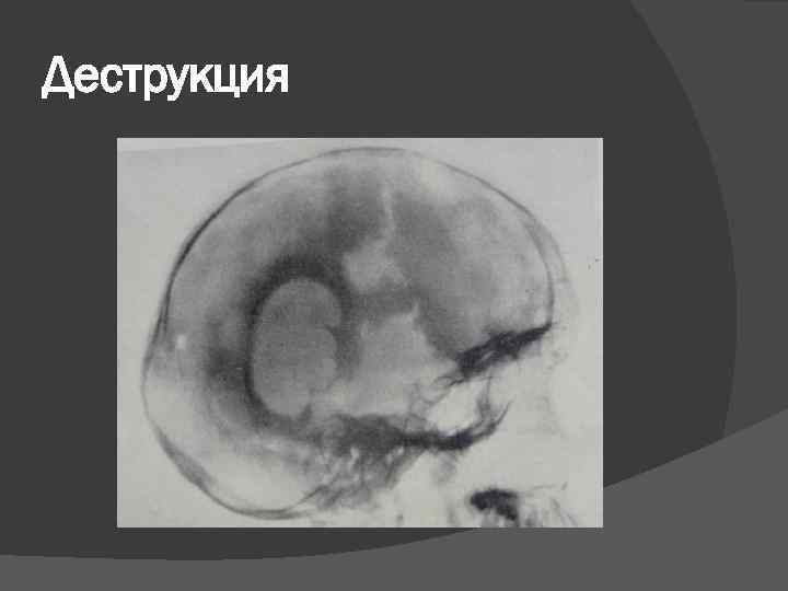 Деструкция 