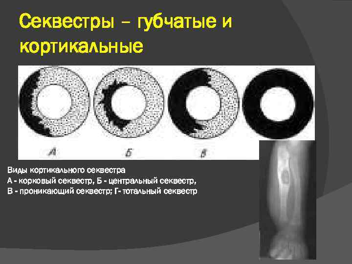 Секвестры – губчатые и кортикальные Виды кортикального секвестра А - корковый секвестр, Б -