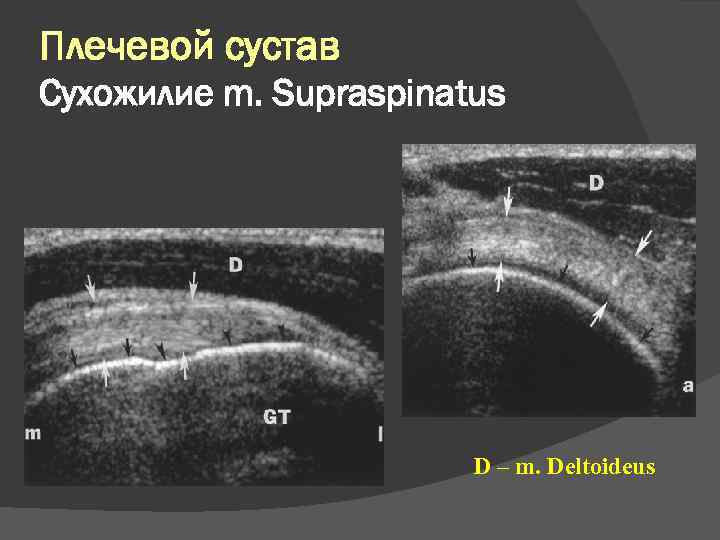 Плечевой сустав Сухожилие m. Supraspinatus D – m. Deltoideus 
