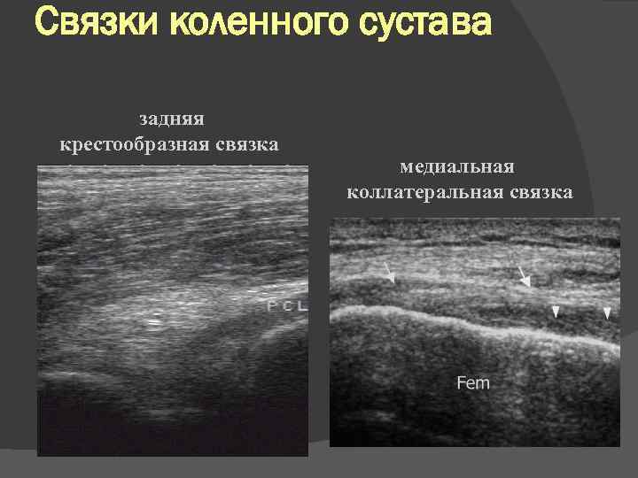Связки коленного сустава задняя крестообразная связка медиальная коллатеральная связка 