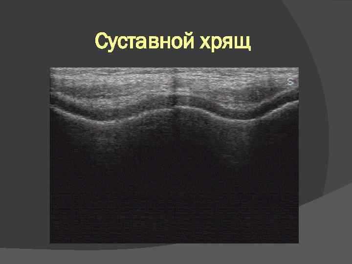 Суставной хрящ 