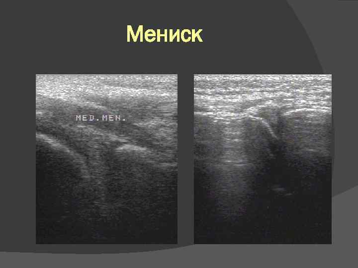 Мениск 