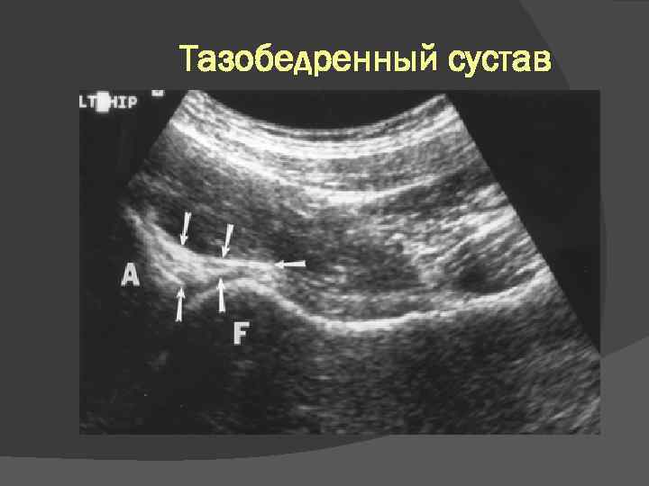 Тазобедренный сустав 