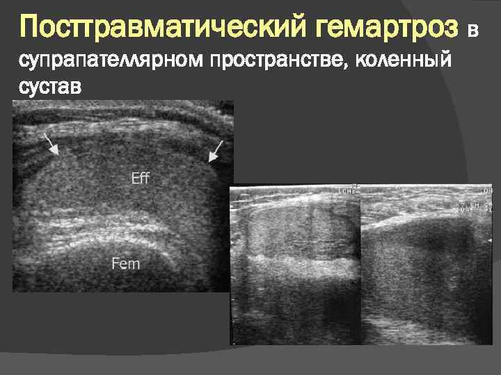 Посттравматический гемартроз в супрапателлярном пространстве, коленный сустав 