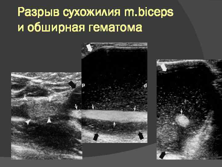 Разрыв сухожилия m. biceps и обширная гематома 