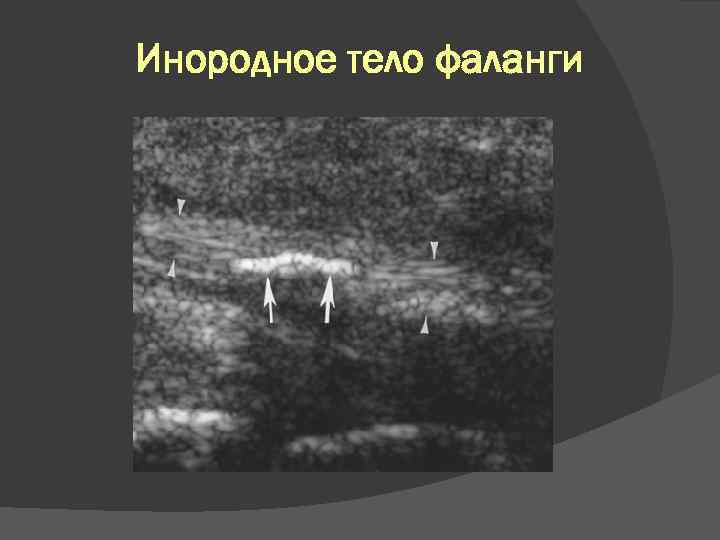 Инородное тело фаланги 