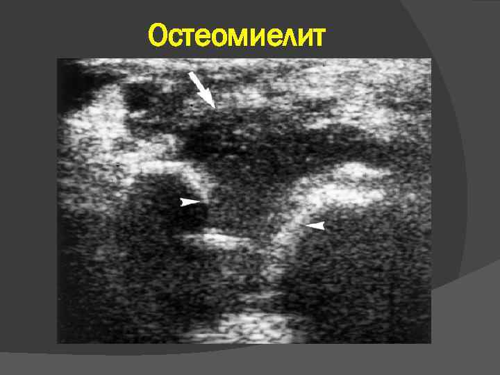 Остеомиелит 