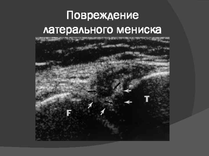 Повреждение латерального мениска 