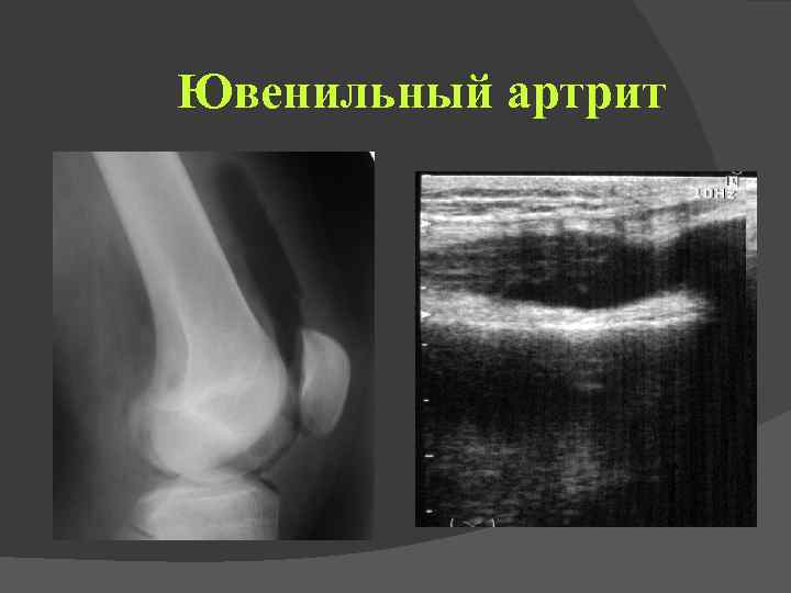 Ювенильный артрит 