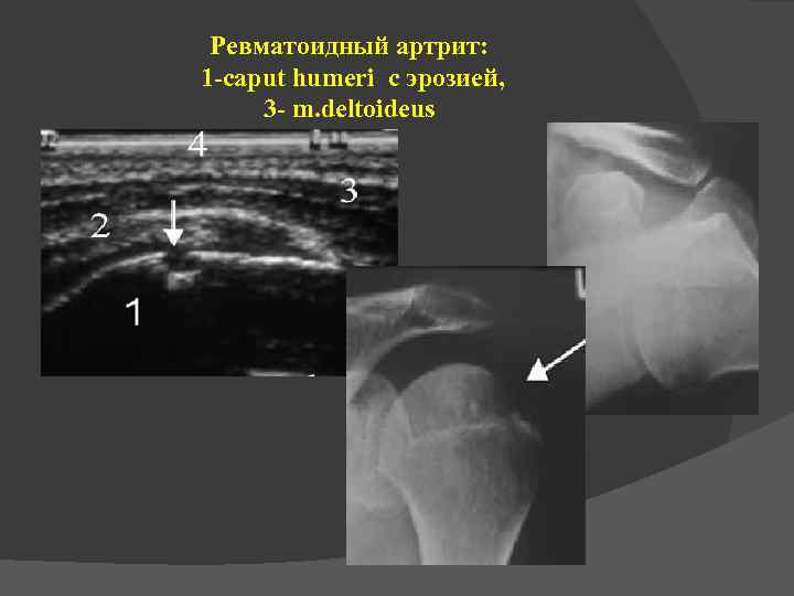 Ревматоидный артрит: 1 -caput humeri с эрозией, 3 - m. deltoideus 