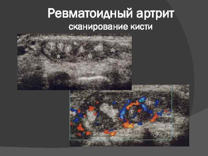 Ревматоидный артрит сканирование кисти 
