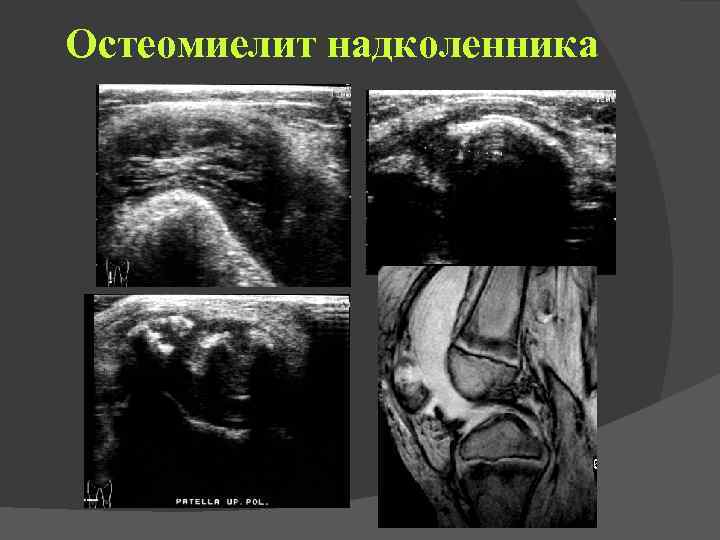 Остеомиелит надколенника 