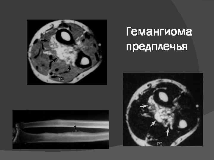 Гемангиома предплечья 