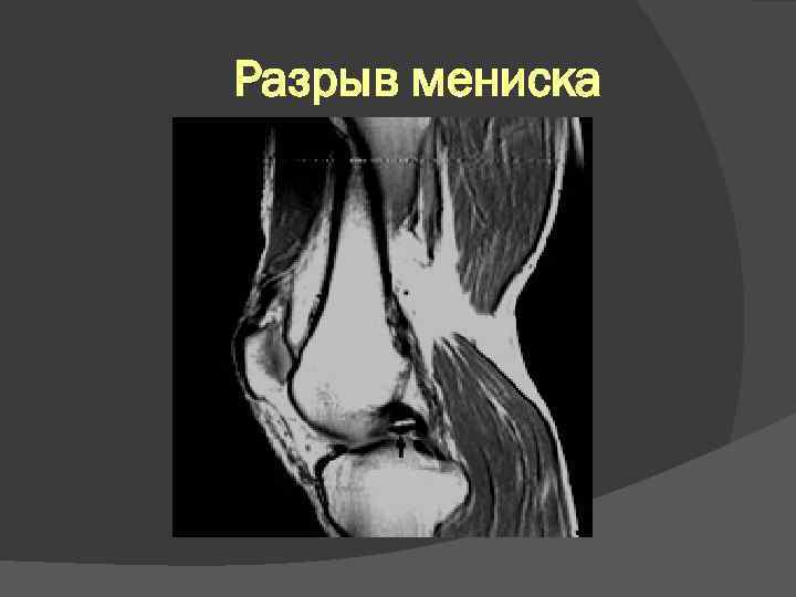 Разрыв мениска 