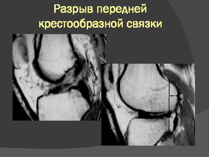 Разрыв передней крестообразной связки 