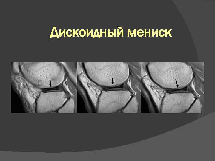 Дискоидный мениск 