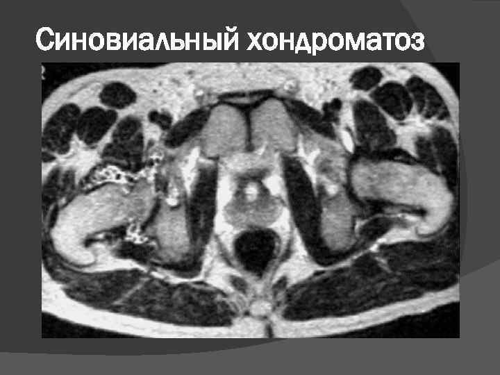 Синовиальный хондроматоз 