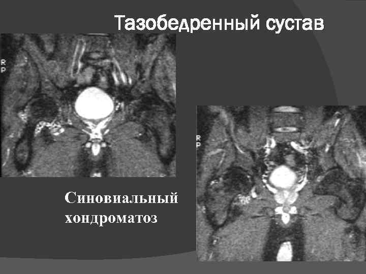Тазобедренный сустав Синовиальный хондроматоз 