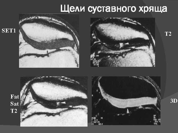 Щели суставного хряща SET 1 Fat Sat T 2 3 D 