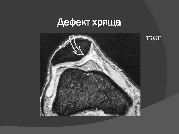 Дефект хряща Т 2 GE 
