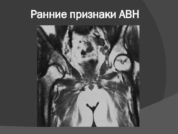 Ранние признаки АВН 