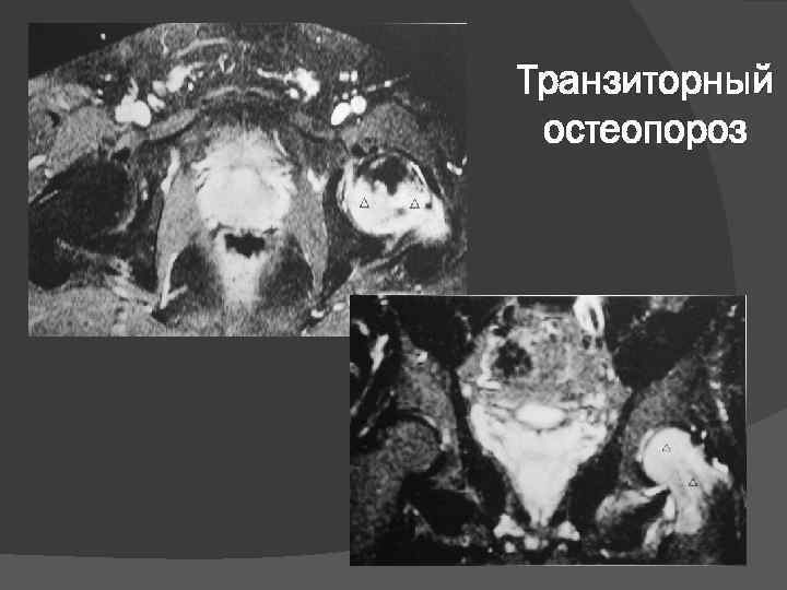Транзиторный остеопороз 