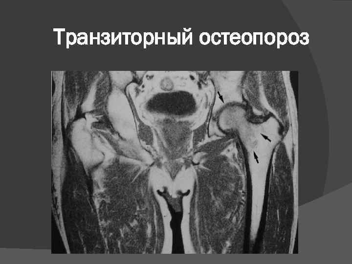 Транзиторный остеопороз 