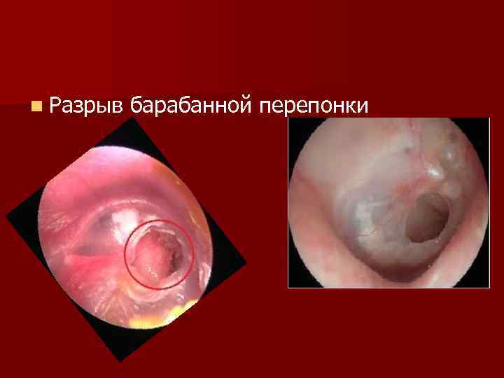 n Разрыв барабанной перепонки 