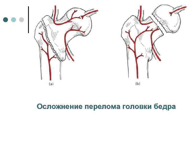 Осложнение перелома головки бедра 