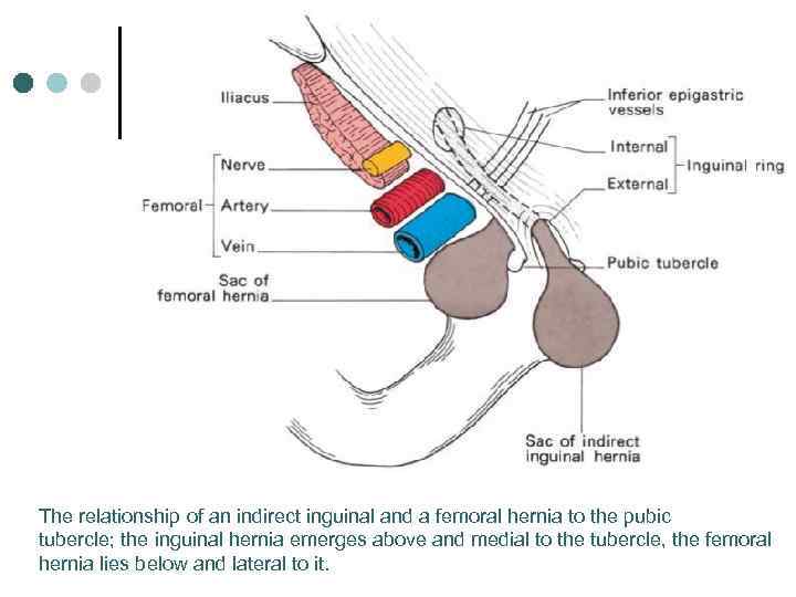 The relationship of an indirect inguinal and a femoral hernia to the pubic tubercle;