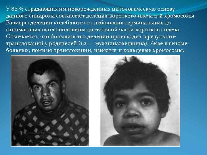 У 80 % страдающих им новорождённых цитологическую основу данного синдрома составляет делеция короткого плеча