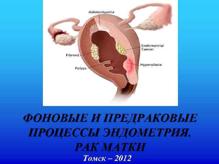 ФОНОВЫЕ И ПРЕДРАКОВЫЕ ПРОЦЕССЫ ЭНДОМЕТРИЯ. РАК МАТКИ Томск – 2012 