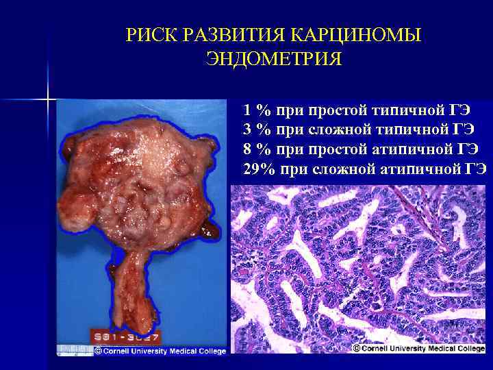 РИСК РАЗВИТИЯ КАРЦИНОМЫ ЭНДОМЕТРИЯ 1 % при простой типичной ГЭ 3 % при сложной