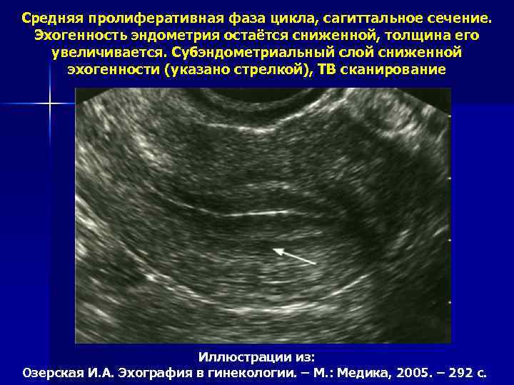 Средняя пролиферативная фаза цикла, сагиттальное сечение. Эхогенность эндометрия остаётся сниженной, толщина его увеличивается. Субэндометриальный