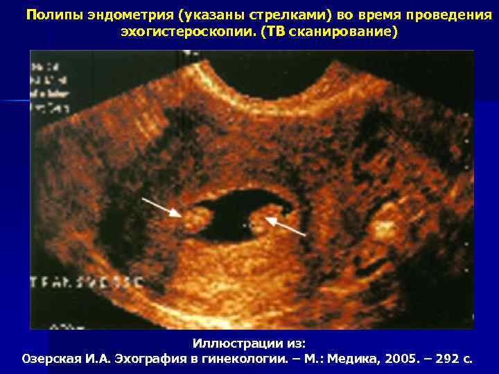 Полипы эндометрия (указаны стрелками) во время проведения эхогистероскопии. (ТВ сканирование) Иллюстрации из: Озерская И.