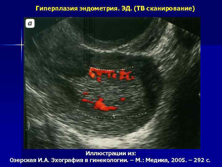 Гиперплазия эндометрия. ЭД. (ТВ сканирование) Иллюстрации из: Озерская И. А. Эхография в гинекологии. –