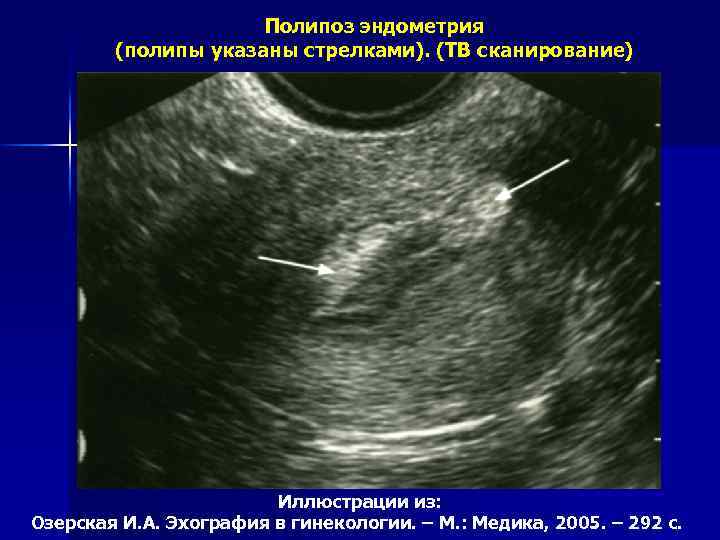 Полипоз эндометрия (полипы указаны стрелками). (ТВ сканирование) Иллюстрации из: Озерская И. А. Эхография в