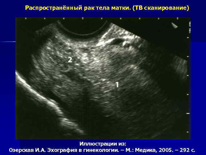 Распространённый рак тела матки. (ТВ сканирование) Иллюстрации из: Озерская И. А. Эхография в гинекологии.