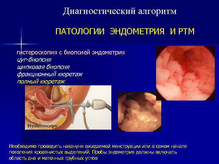 Диагностический алгоритм ПАТОЛОГИИ ЭНДОМЕТРИЯ И РТМ гистероскопия с биопсией эндометрия цуг-биопсия щипковая биопсия фракционный