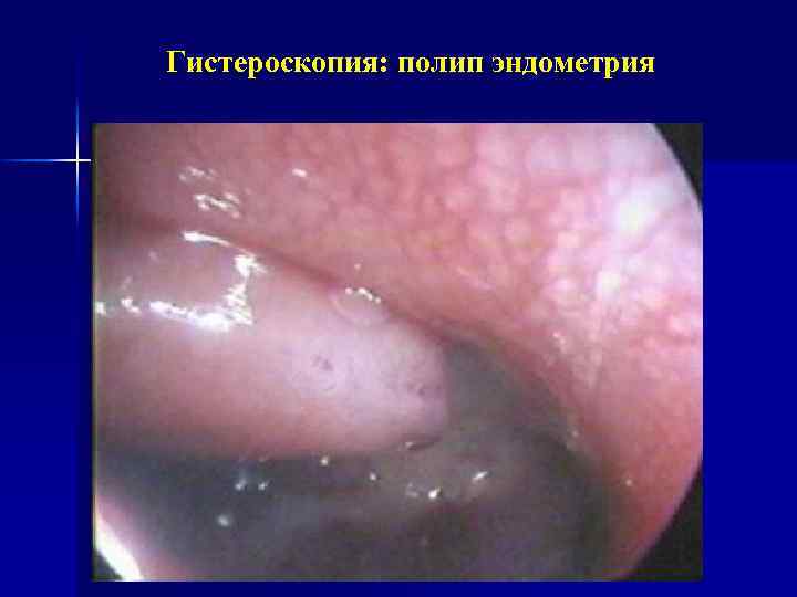 Гистероскопия: полип эндометрия 