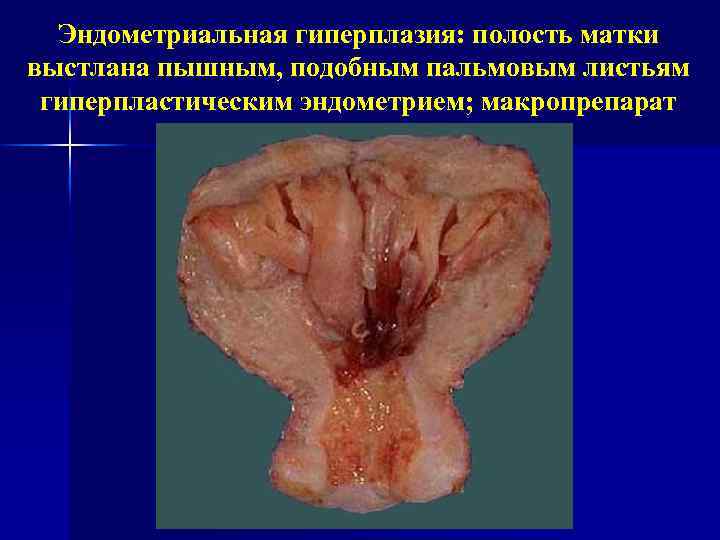 Эндометриальная гиперплазия: полость матки выстлана пышным, подобным пальмовым листьям гиперпластическим эндометрием; макропрепарат 