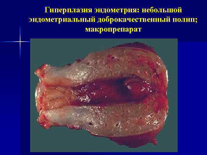 Гиперплазия эндометрия: небольшой эндометриальный доброкачественный полип; макропрепарат 